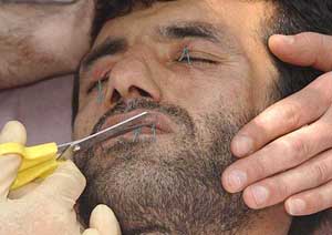 Iranian refugee Abbas Amini has the stitches, which had kept his mouth closed for nine days, cut by a nurse