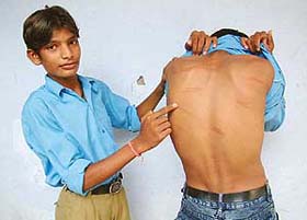 A student shows scars on his back as a result of the corporal punishment in Government Senior Secondary School, Amritsar