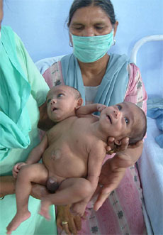 An attendant with conjoined twins