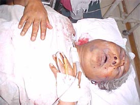 Kailash Wanti, who was injured by robbers in Ludhiana