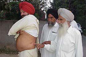 A relative showing the scar of a kidney operation on Gurdit Singh