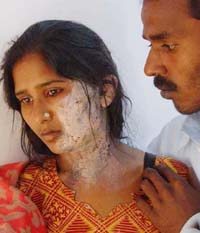 Ms Baby, with burnt face, and her husband Ashok Kumar in the office of Punjab State Commission
