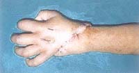 Post-operation snaps of a four-year-old child�s stitched hand. 