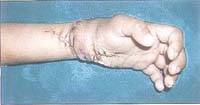 Post-operation snaps of a four-year-old child�s stitched hand. 