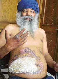 Balbir Singh an alleged victim of torture by the Khanna Police