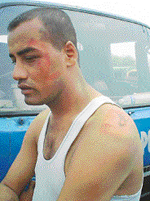 Sanjay, a resident of New Shiv Puri, who was allegedly subjected to torture at Basti Jodhewal police station in Ludhiana on Tuesday.