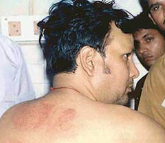 Mr Pawan Garg, a BJP leader, shows injuries on his back that he suffered after he was allegedly beaten up by some policemen.