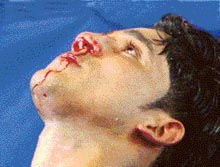 Sandeep Kumar of Delhi tries to control the bleeding from his nose after a boxing bout with Gautam of Punjab in the final round of the Northern India Boxing Meet in Chandigarh