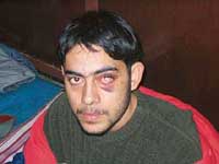Gurpreet Singh, whose left eye was badly bruised in torture by Turkish guards.