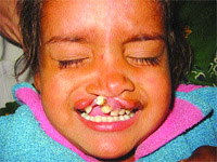 Manisha, a girl, suffering from cleft lip.