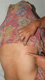 The victim shows the injury marks.
