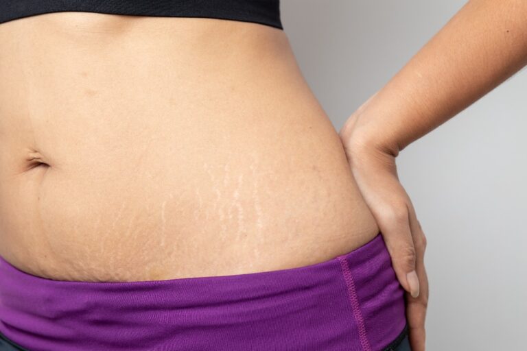 Prevent Stretch Marks