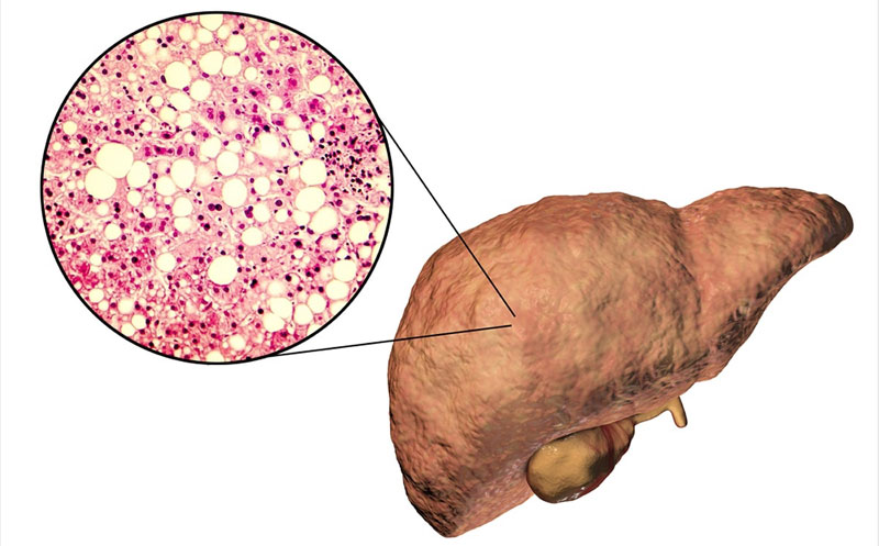 A glance at Fatty Liver Disease