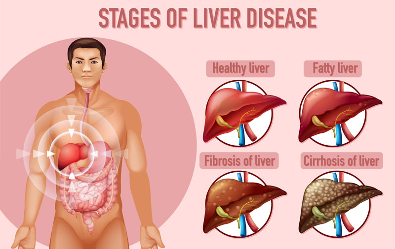 Fatty Liver the challnge of next decade; Let’s know it and prevent it.