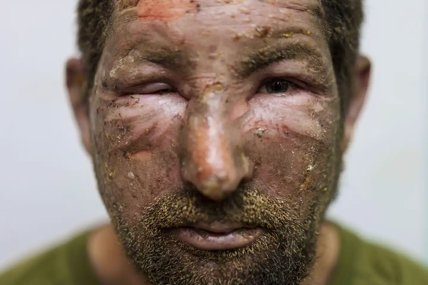 Drones complican evacuaciones médicas en Ucrania