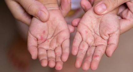 Cancelan eventos masivos en municipios de Chiapas por sarampión