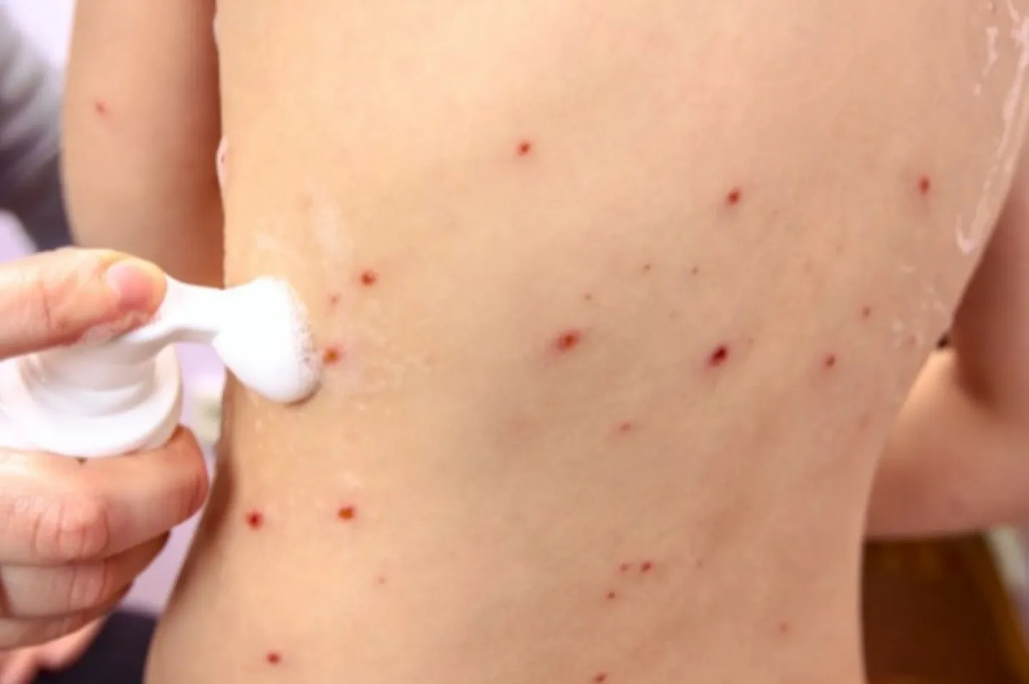 Gobierno en alerta ante contagios de sarampión