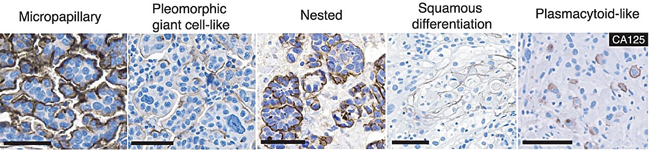 Particle News: UCSF Researchers Target Variant Bladder Cancer With CAR ...