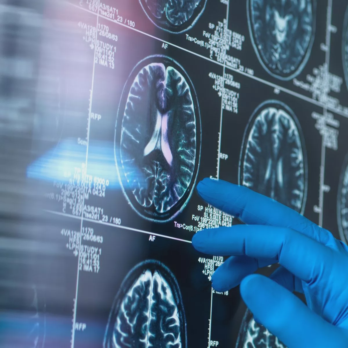 Particle News: More Muscle and Less Visceral Fat Linked to Younger ...
