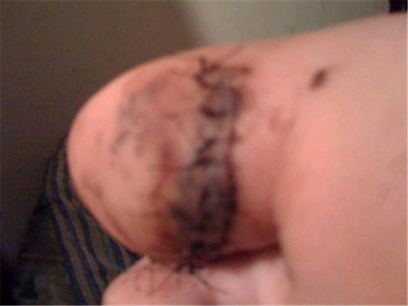 Most Stitches In A Hallux