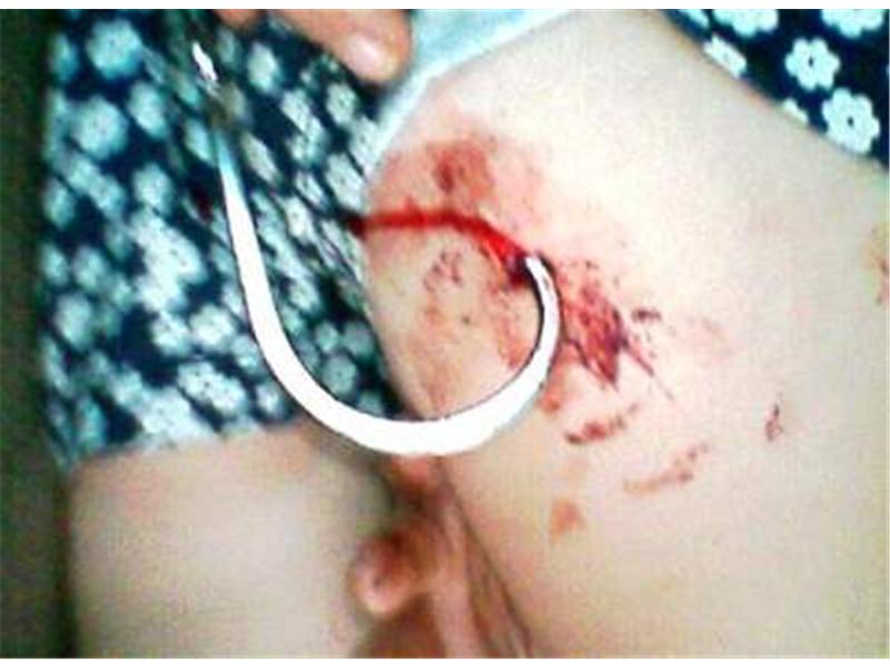 Most Shark Hooks Hooked In Body