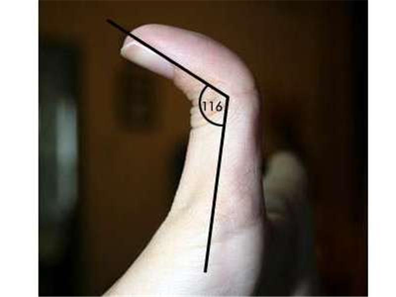 Greatest Backwards Bend In Top Joint Of Thumb