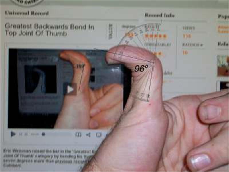 Greatest Backwards Bend In Top Joint Of Thumb