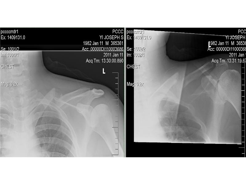 Longest Time With Broken Clavicle Before Having Surgery