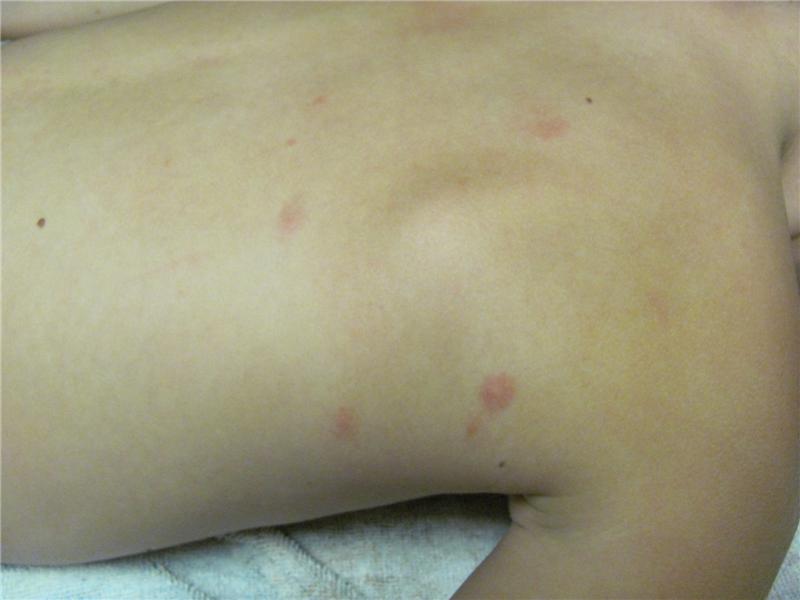 Most Mosquito Bites At Once