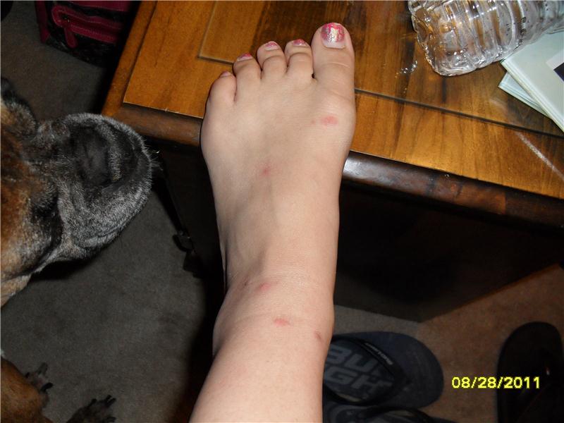 Most Mosquito Bites At Once