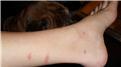 Most Mosquito Bites At Once