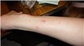 Most Mosquito Bites At Once