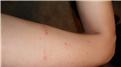 Most Mosquito Bites At Once