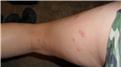 Most Mosquito Bites At Once
