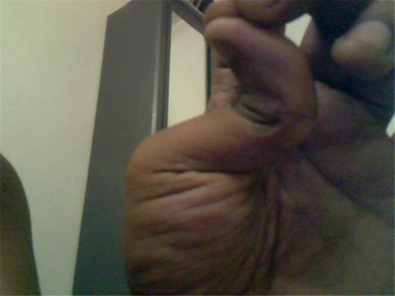 Greatest Backwards Bend In Top Joint Of Thumb