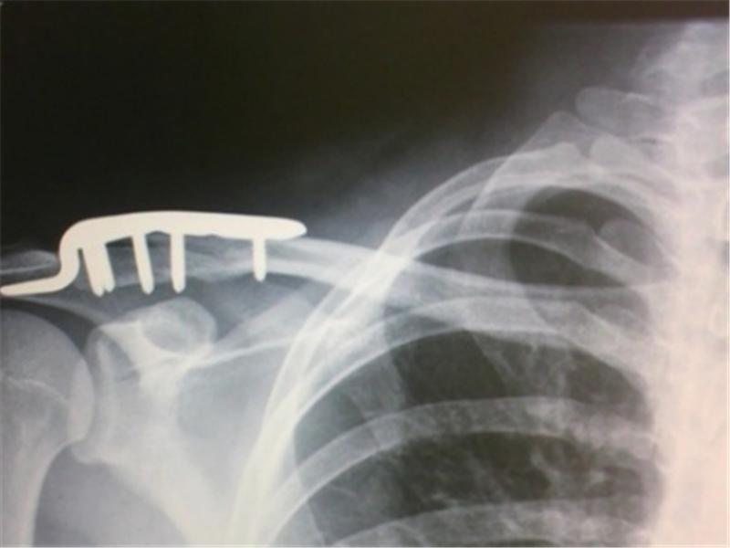 Most Screws In A Clavicle Bone