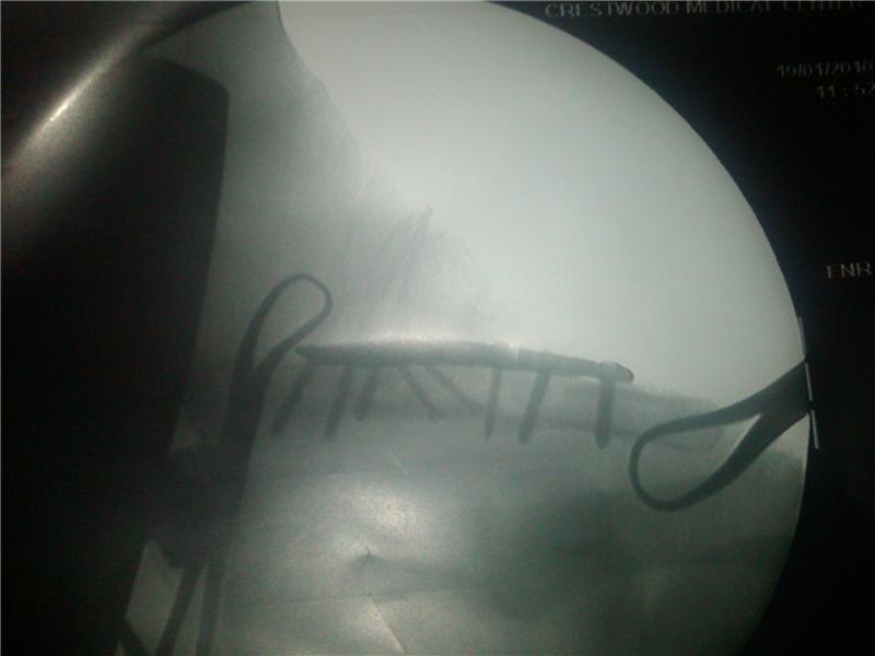 Most Screws In A Clavicle Bone