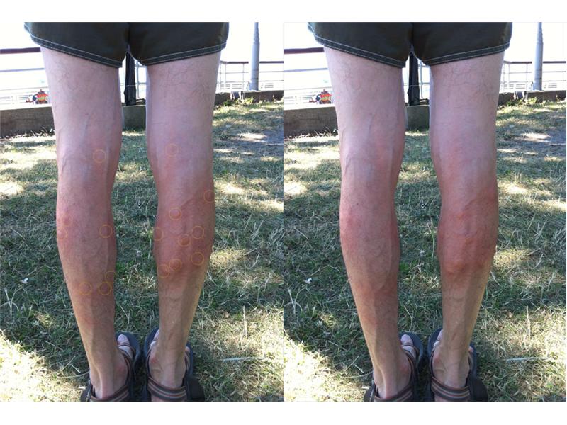 Most Mosquito Bites At Once