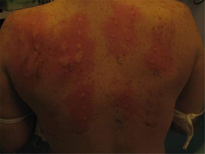 Most Allergic Reactions In 15 Minutes