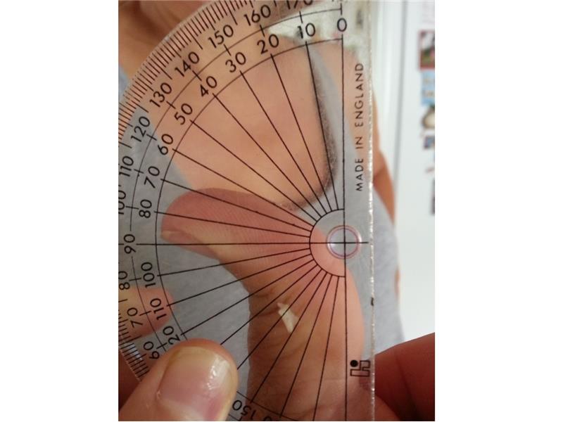 Greatest Backwards Bend In Top Joint Of Thumb