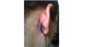 Most Stitches In An Ear