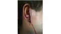 Most Stitches In An Ear