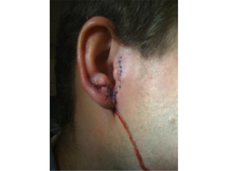 Most Stitches In An Ear