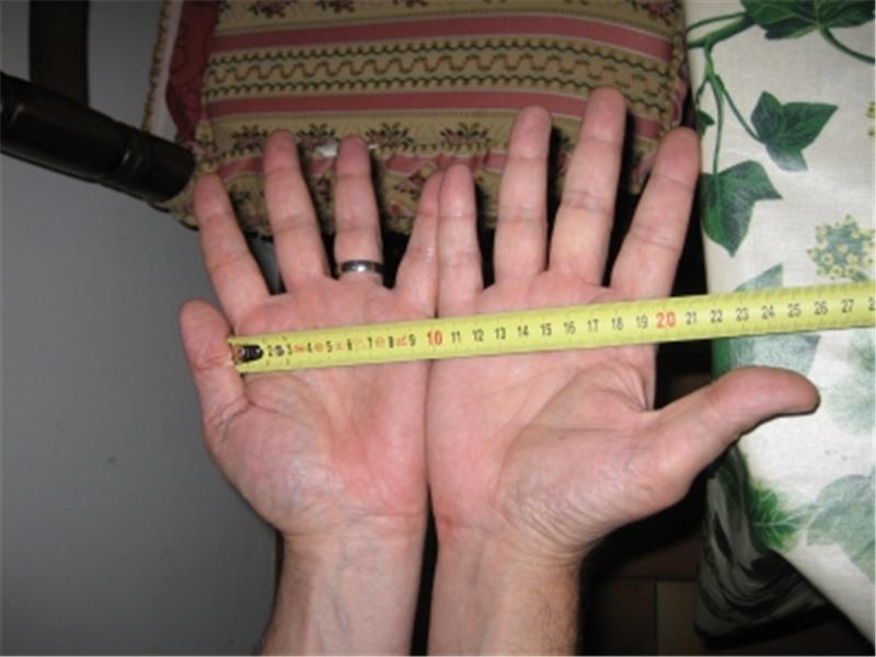 Longest Single Transverse Palmar Crease Across Two Hands