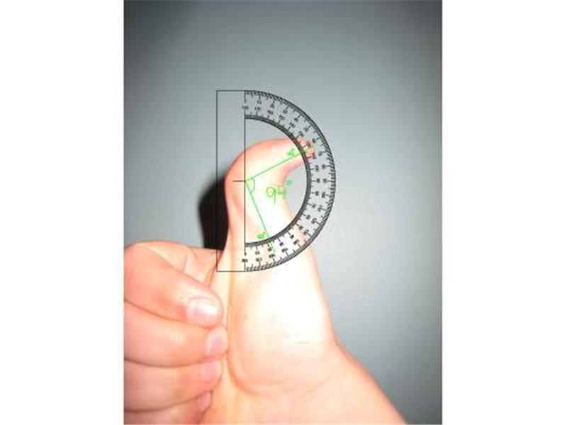 Greatest Backwards Bend In Top Joint Of Thumb