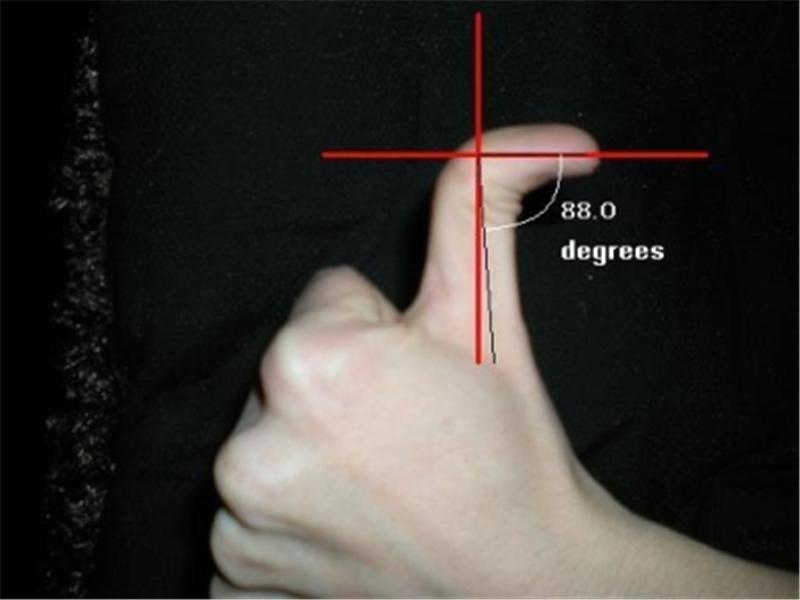 Greatest Backwards Bend In Top Joint Of Thumb