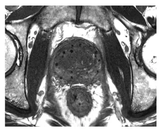 MRI visualization of critical intraprostatic structures and soft tissue differentiation.