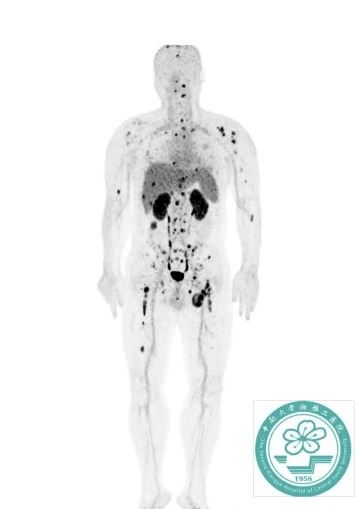 Companion Diagnostic: VMT02