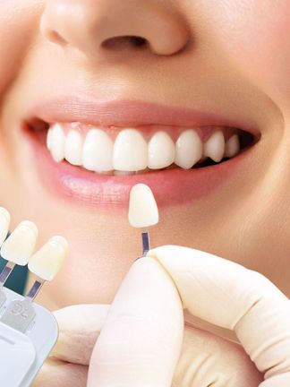 Smile Makeover Process - Matching Veneers Colors with Natural Teeth