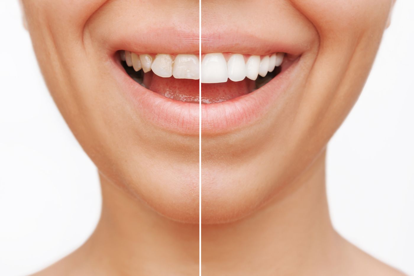Veneers Before After